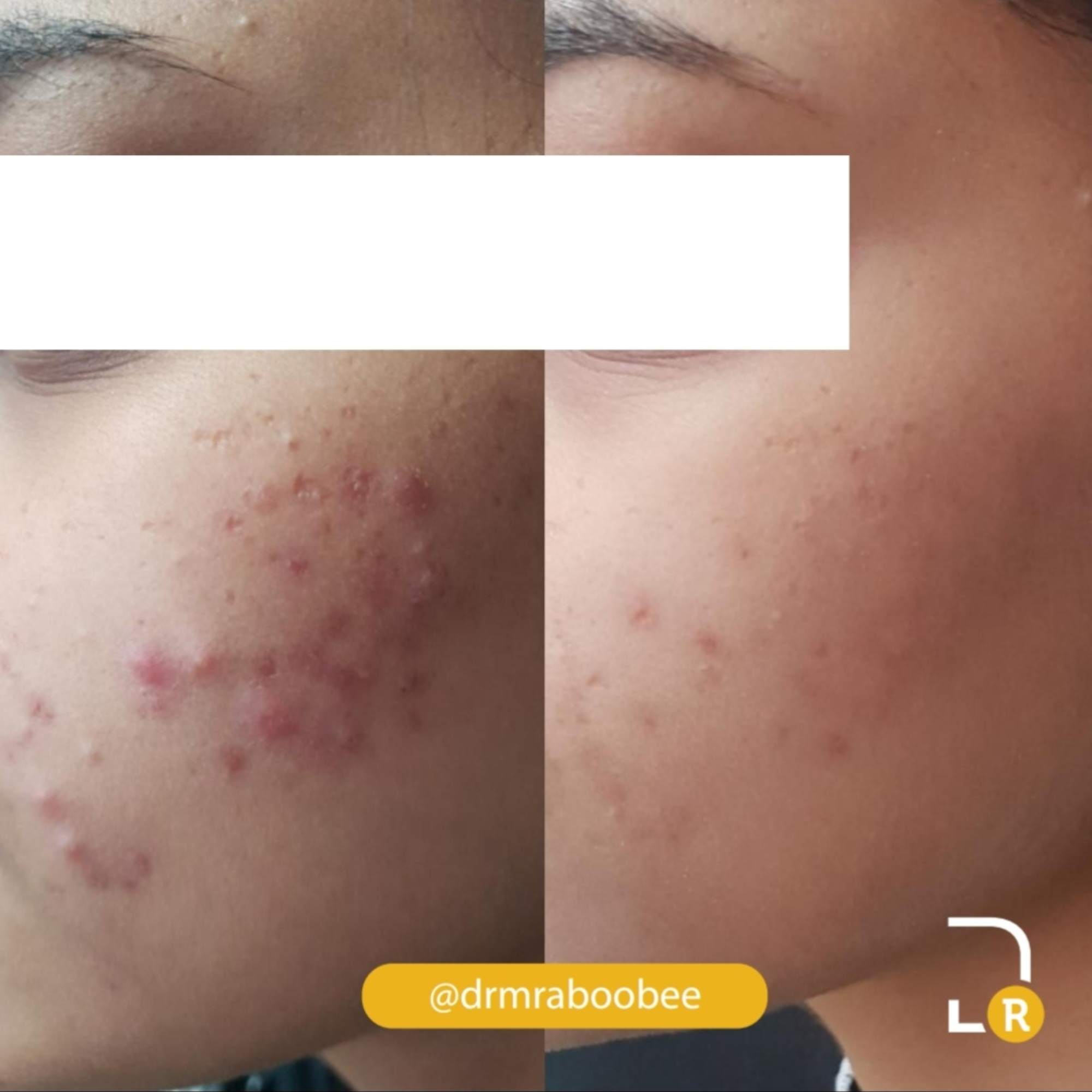 Enerpeel Salicylic Acid 15% - Image 6