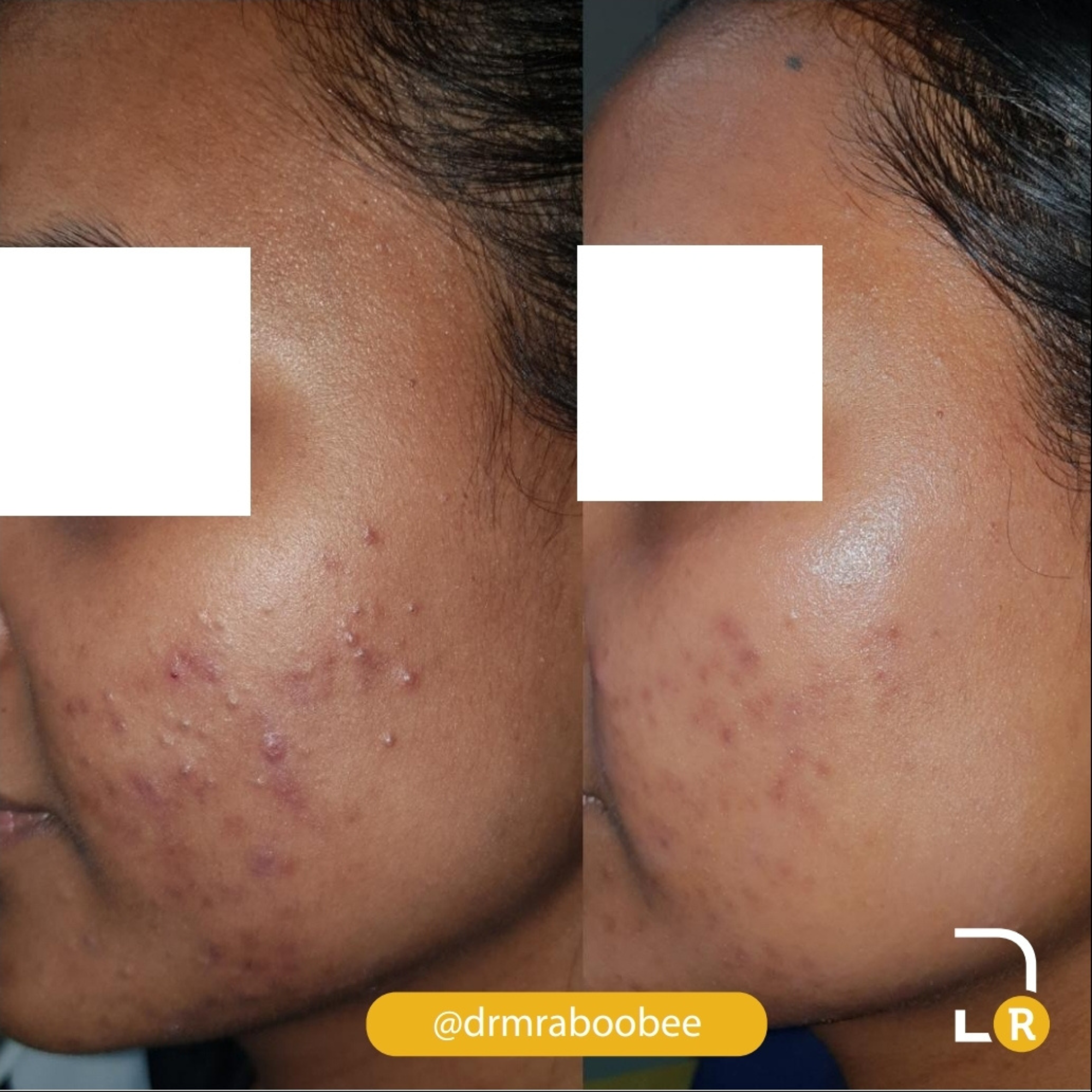 Enerpeel Salicylic Acid 15% - Image 7